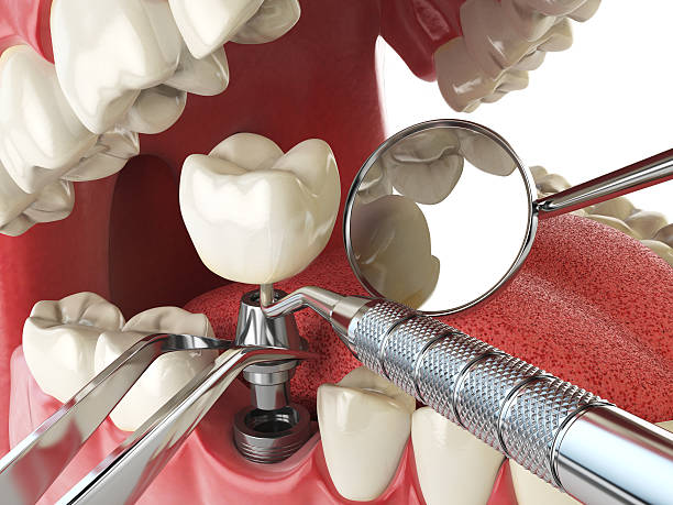 Best Emergency Tooth Extraction in Summitville, IN
